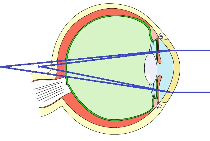 Converting A Glasses Prescription To Contact Lenses Compound Hyperopic Astigmatism