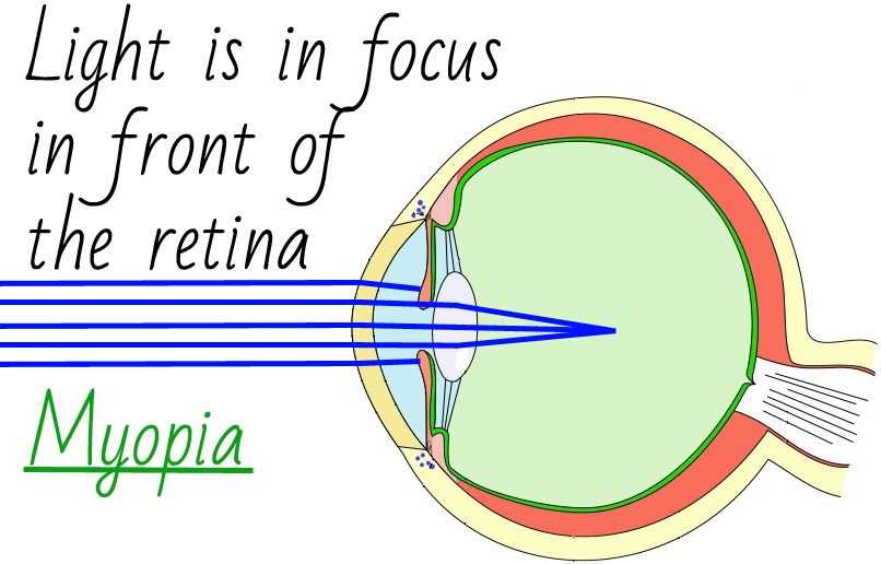 Light Is In Focus In Front Of The Retina