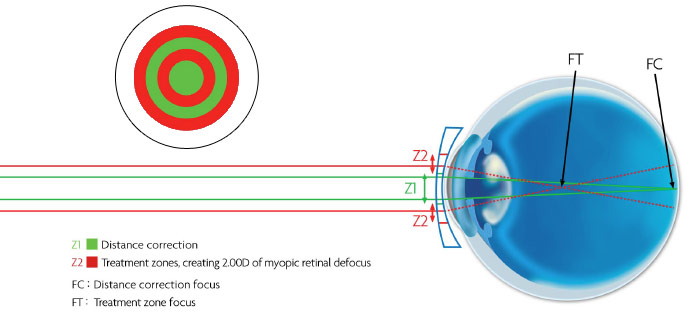 Misight Contact Lenses ActivControl Technology