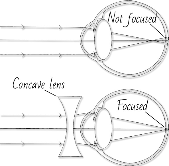 Myopia Ray Diagram