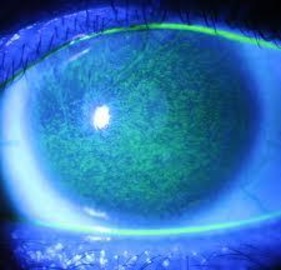 Why Are My Contacts Blurry Superficial Punctate Keratitis