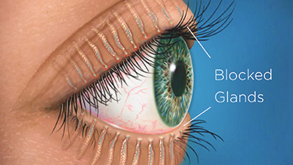 Blocked Glands