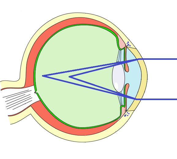Compund Myopic Astigmatism